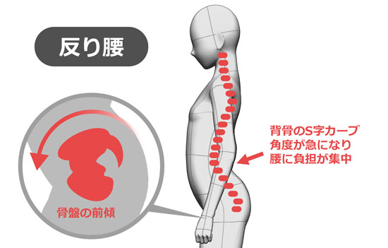 ガードナーベルト反り腰イメージ